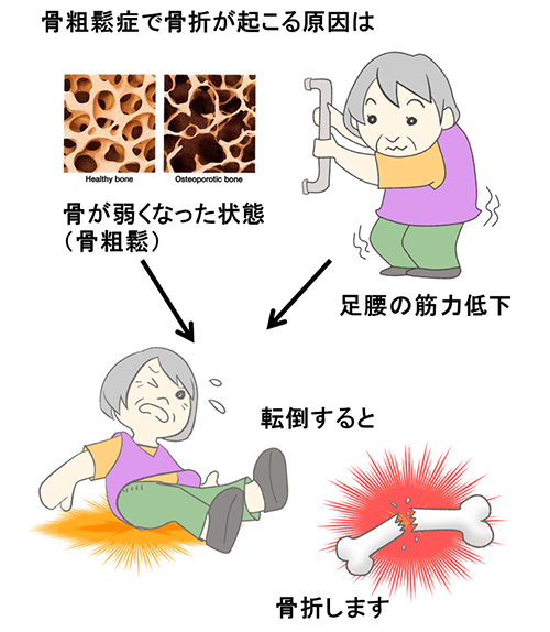 骨粗鬆症で骨折が起こる原因